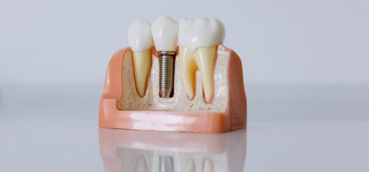 Jakie są rodzaje protez zębowych?